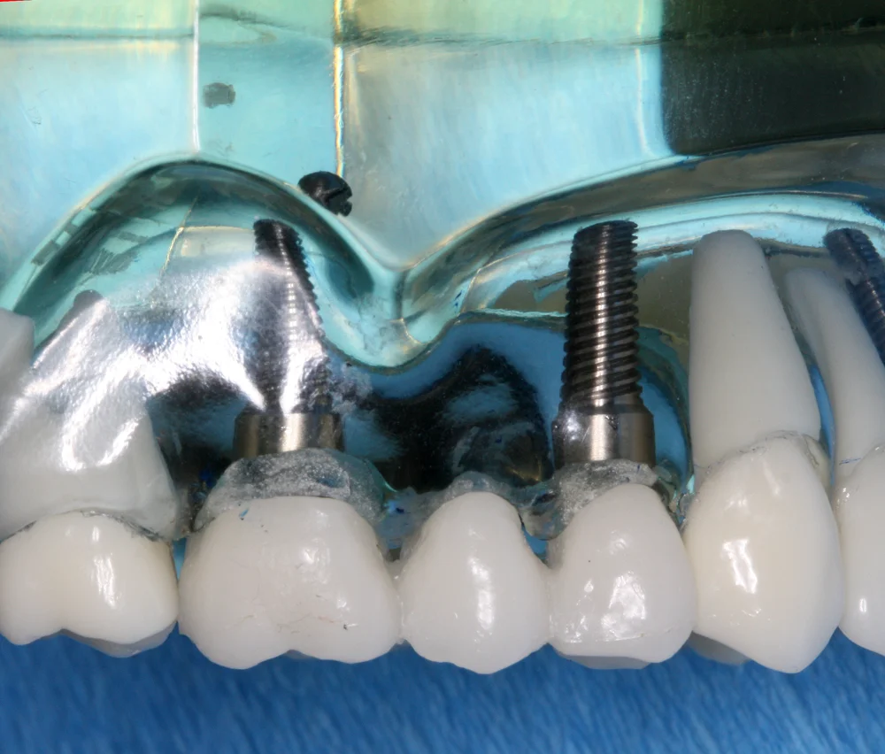 Ponte de três dentes apoiada em dois implantes, com um pôntico no meio